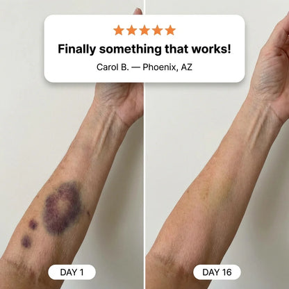 Livara: Finally, A Cream That Fades Bruises On Fragile Skin